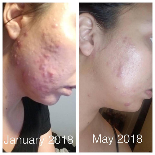 Super Acne Fighter / Organic Acne Treatment / Acne - Image 3