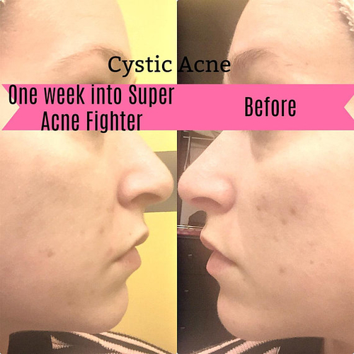 Super Acne Fighter / Organic Acne Treatment / Acne - Image 4